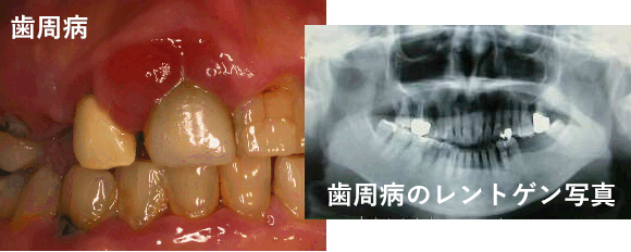 歯周病のレントゲン写真