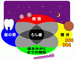 虫歯になる4条件