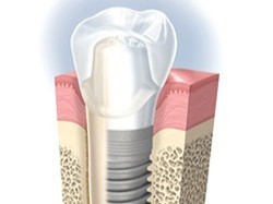 自然な見た目と噛み心地を取り戻すことができます