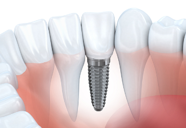 天然歯のような美しさと機能性を持つインプラント