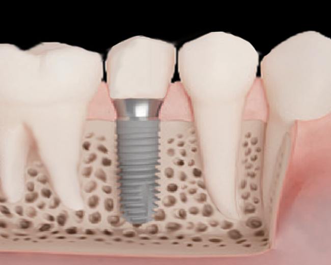 専門医によるインプラント治療
