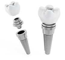 インプラント治療が注目されています