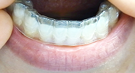 取り外し可能なマウスピース矯正も人気です