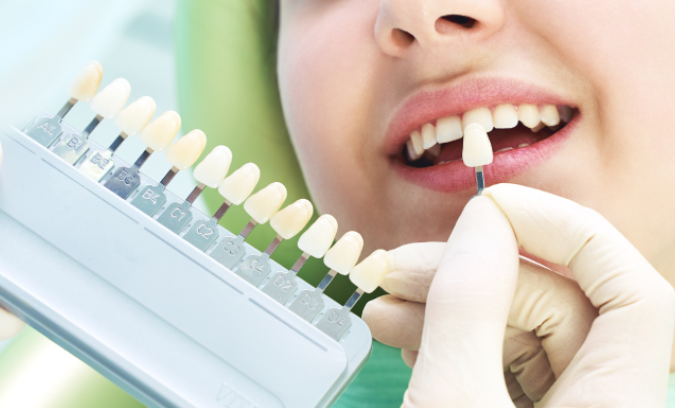 セルフホワイトニングもあります