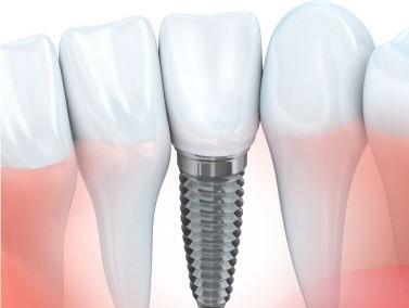 歯を失った部分を補う治療としてインプラントを提供しています