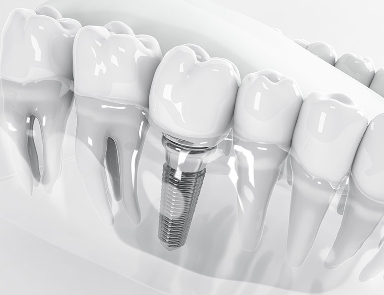 自然な噛み心地と見た目の回復を目指して