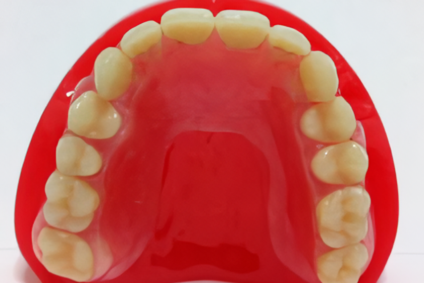 金具を使わない入れ歯