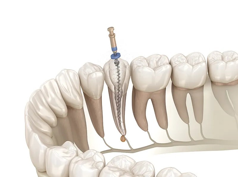 ダメージを受けた神経を取り除き、歯の内部を洗浄・消毒して虫歯の進行を止める治療が根管治療です