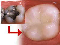 なるべく削らない治療を優先します。