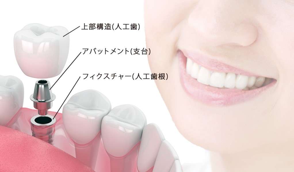 品川デンタルケアクリニック　品川院はストローマン社製（Straumann）インプラントを採用しております