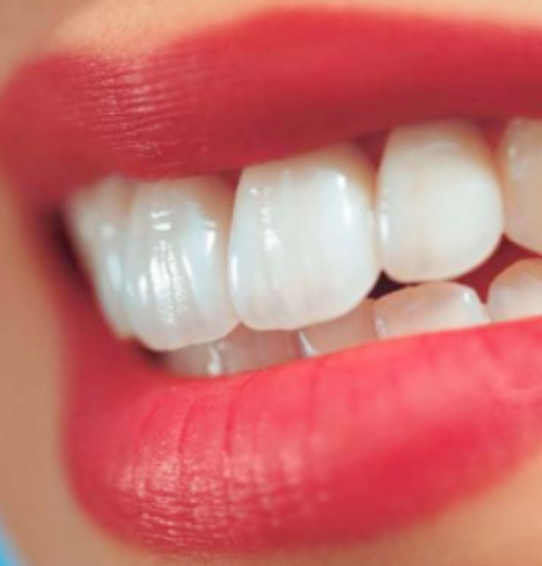 ホワイトニング治療で歯を美しく