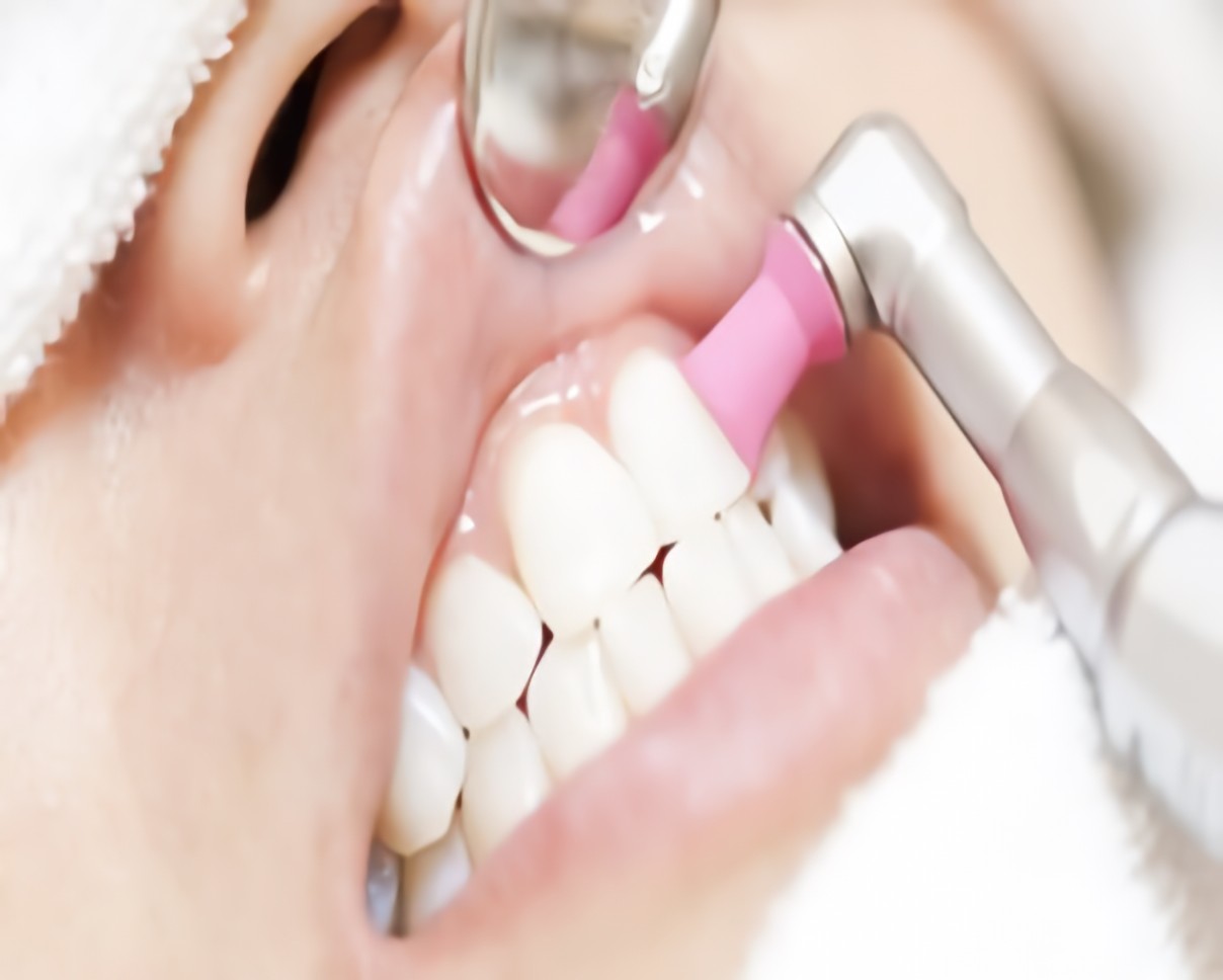 歯のクリーニング