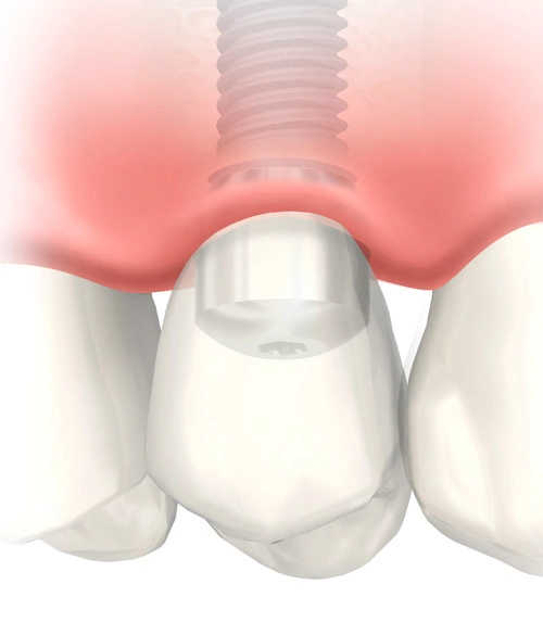 失った歯を取り戻すインプラント治療。