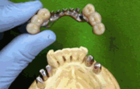 個々の患者様のニーズや希望に合わせて、さまざまな種類や材料から選び、最適な義歯を提供します。