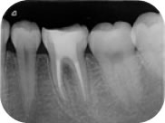 丁寧な根管治療で歯を残すことが可能になります