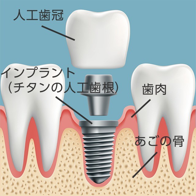 入れ歯が合わず、食事や会話に不自由を感じている方にとって、インプラント治療は有効な選択肢です。