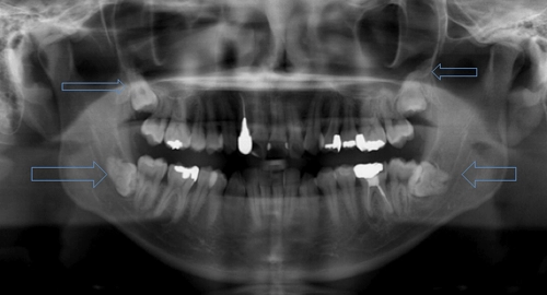 神経や血管の位置を正確に把握したうえで、安全な抜歯計画を立てています