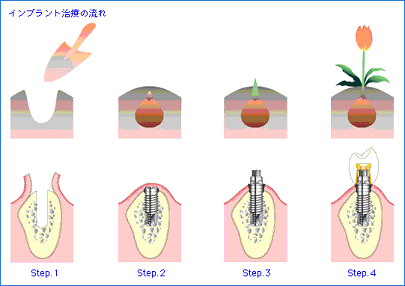 インプラントとは植立を意味します