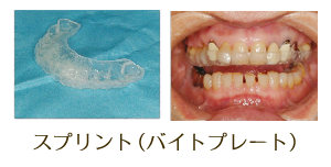 顎関節症の治療例