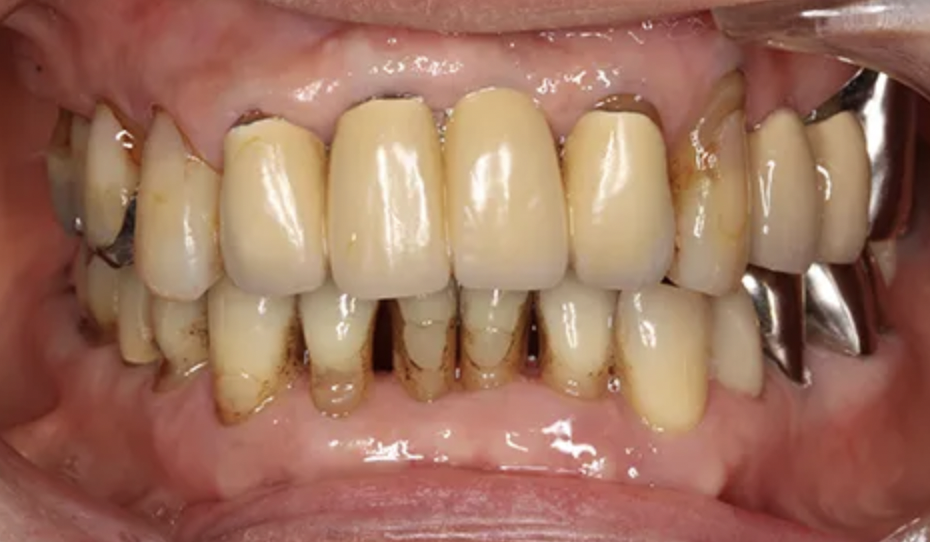 歯周病と関連がある全身疾患リスク予防のための治療