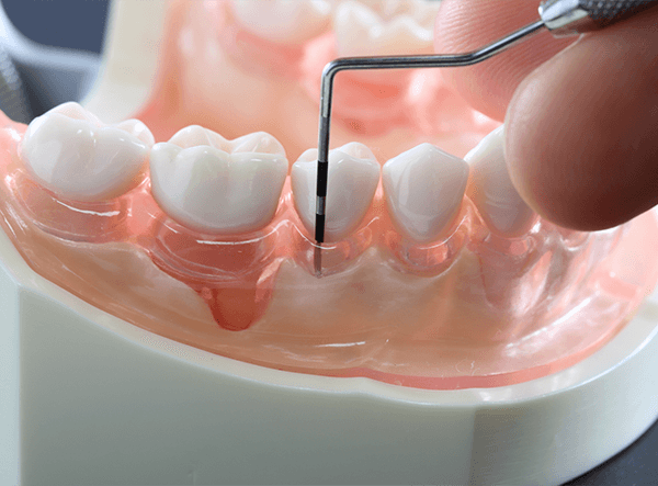 歯周病の進行を抑止しましょう