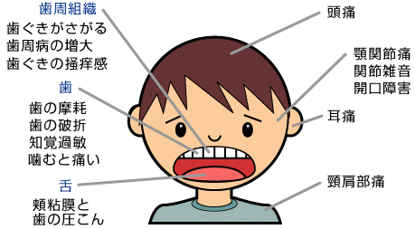 マウスピース法でブラキシズムを弱めるよう対処します