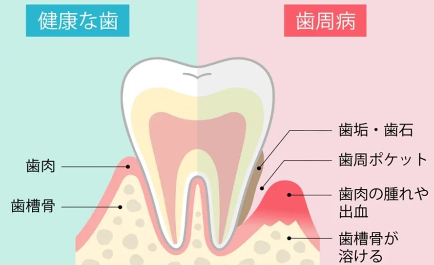 歯の支えを徐々に溶かしていきます