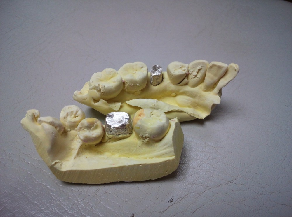 技工室で製作した金属製のコアです