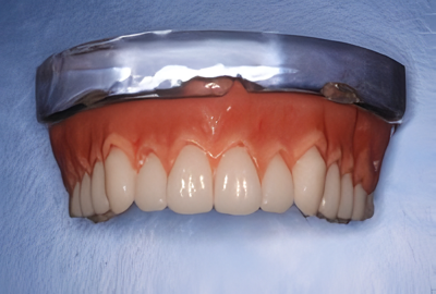 金属不使用で審美性抜群