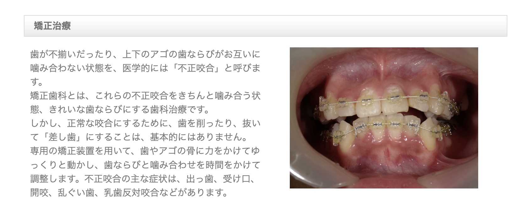 歯並びや噛み合わせを整えることで、噛む機能の向上や歯の健康維持にもつながります