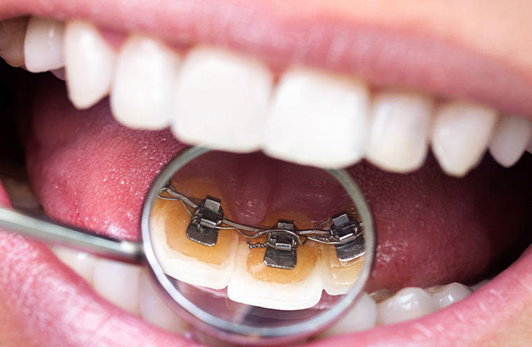 フルリンガルブラケット矯正装置