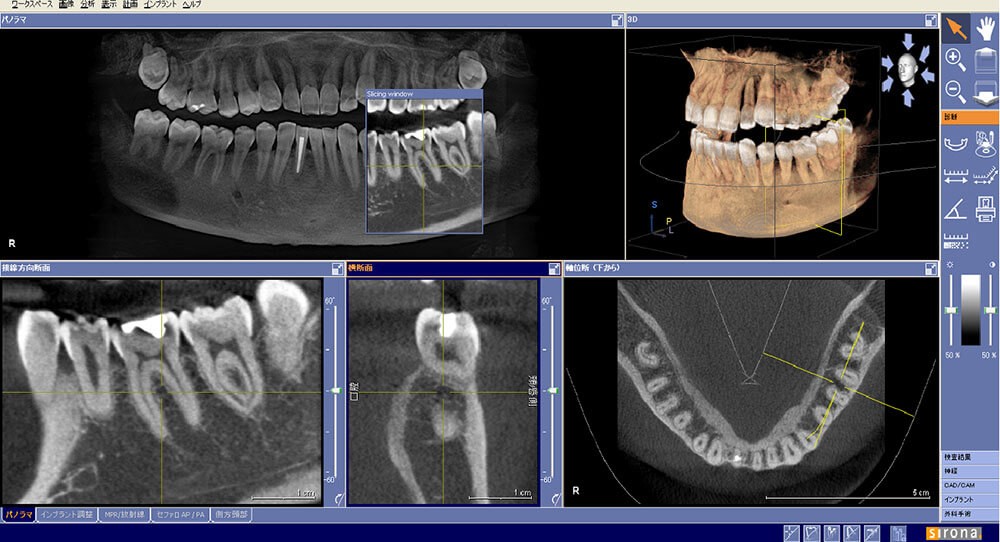 3D解析を可能にする歯科用CTを導入済み