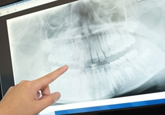 難症例の親知らず抜歯から顎関節症まで幅広く対応