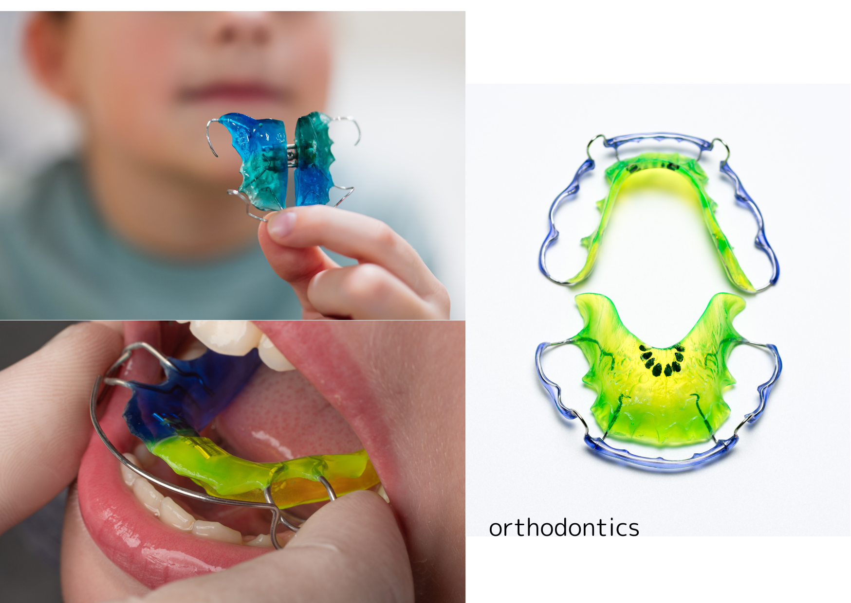 必要に応じてブラケットやワイヤー矯正も検討します