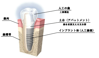 失った歯を取り戻すお手伝いをいたします