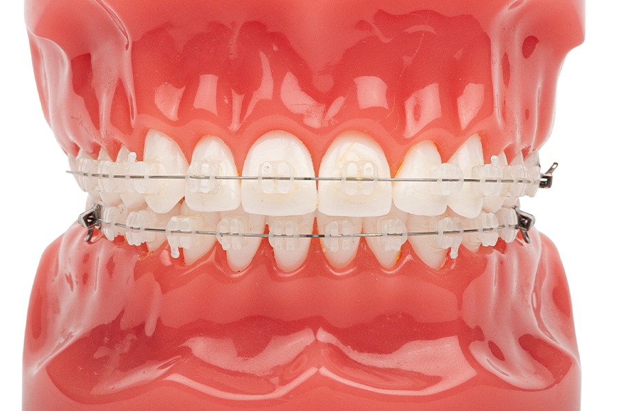 矯正は主に「一期治療」と「二期治療」に分かれます