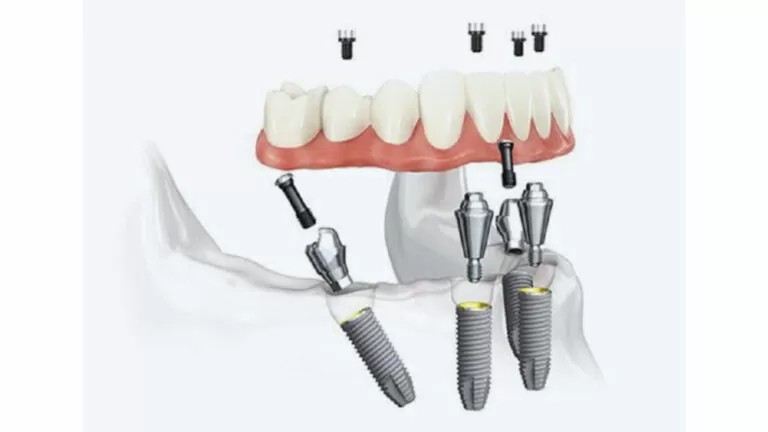 患者様の状態に合わせた無理のない治療計画を提案し、見た目と機能の両立を目指したインプラント治療を提供しています。