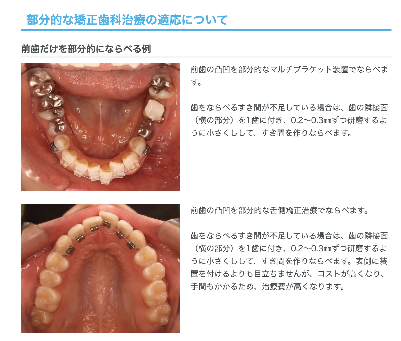 部分矯正治療は、矯正装置を特定の部分に装着し、部分的な歯並びやかみ合わせを改善する治療法です