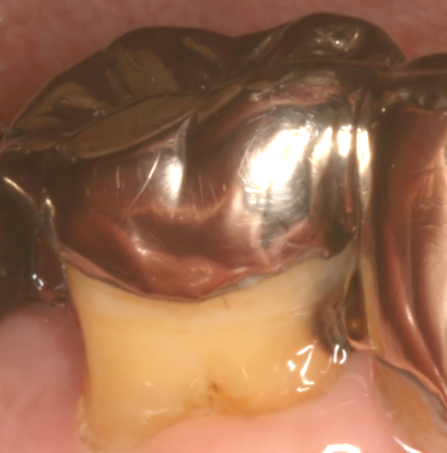 痛みの8割は削らずに改善可能だと言われています