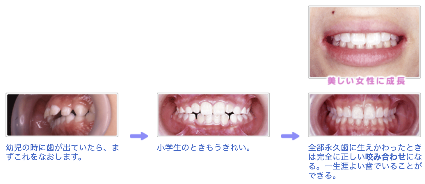 早期矯正で美しい歯に成長します。