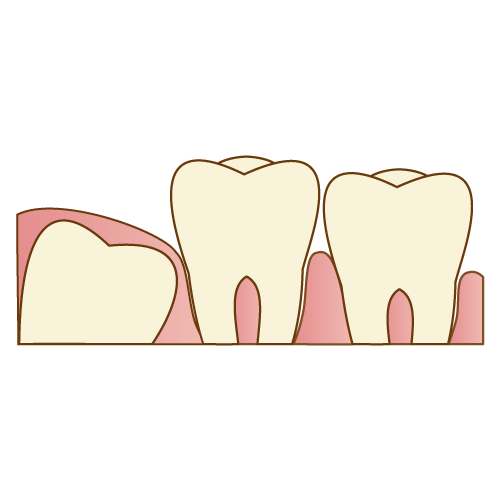 親知らず抜歯も安心、安全な対応