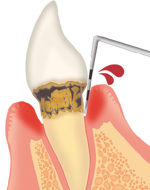 歯周病の検査