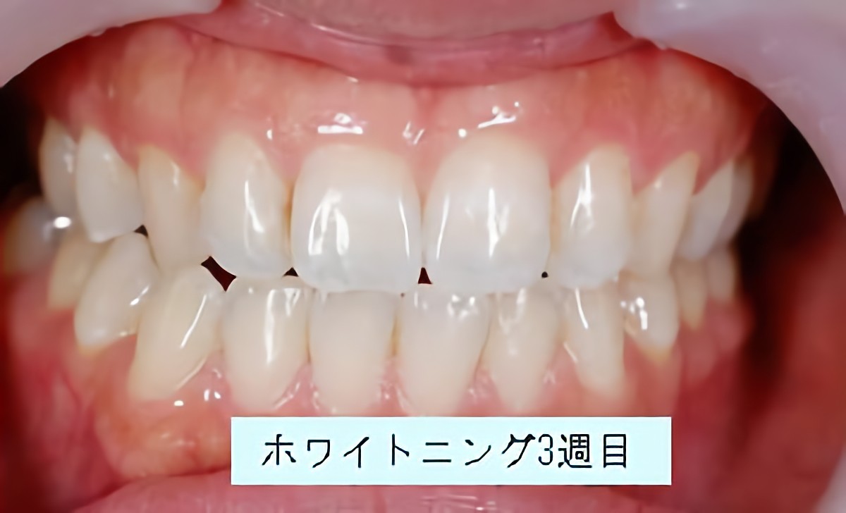 ホームホワイトニングをおすすめしています