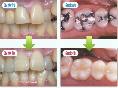 詰め物・かぶせ物において高品質なセラミック素材を用いた治療を提供しています