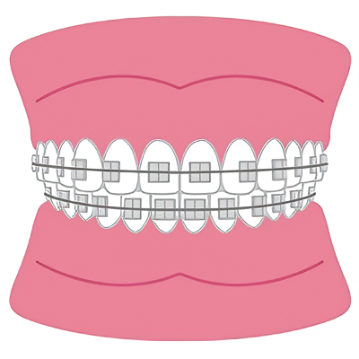 透明で目立ちにくいマウスピース矯正も可能