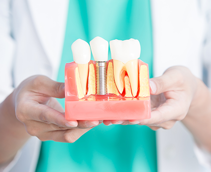 とおる歯科医院が提案するインプラント治療の魅力