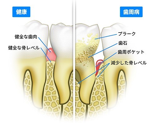 治療の基本は原因であるプラークと歯石の除去、そして再付着を防ぐ口腔環境づくりです。
