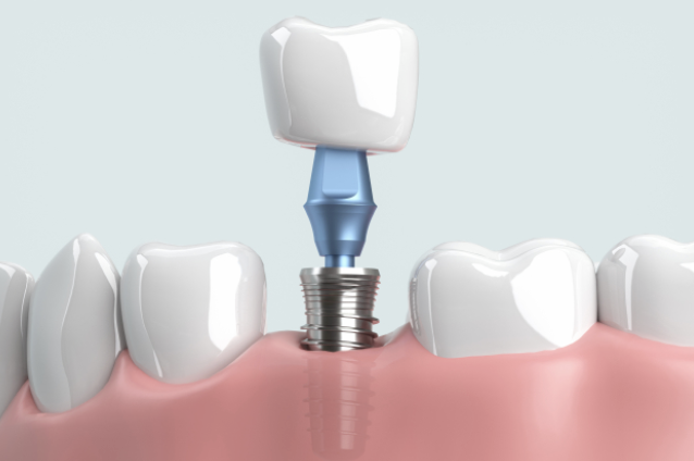 歯科用CTなども完備、安全で確実なインプラント治療を行うことができます。