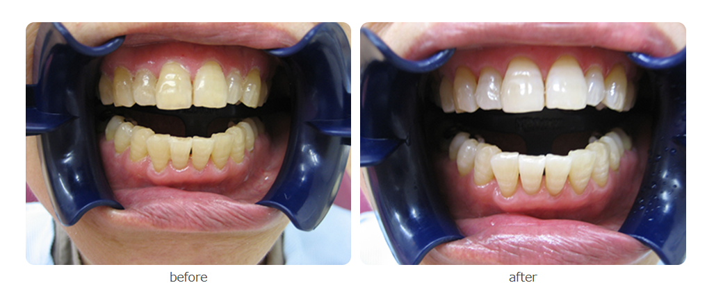 ホワイトニングを受けた患者様の症例