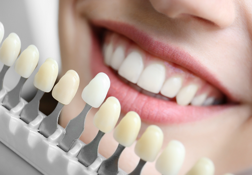 自宅で行えるホワイトニングとセラミック素材で笑顔に自信を